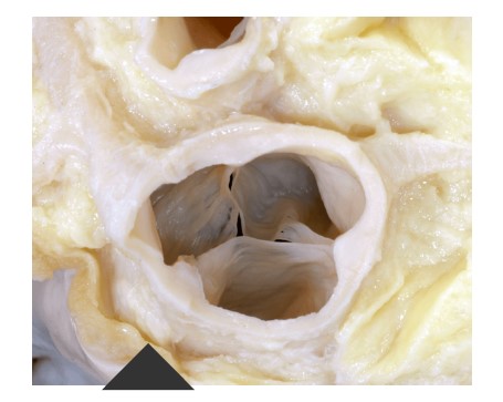 正常の大動脈弁を大動脈側から眺めたところ