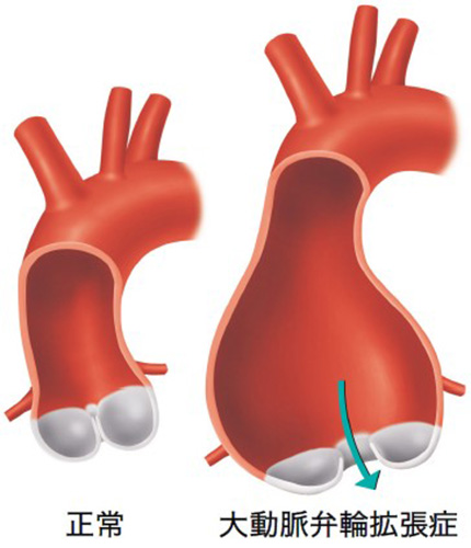 大動脈弁輪拡張症の図