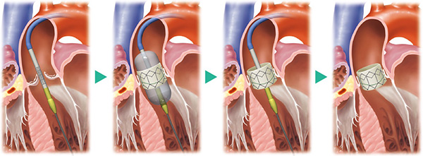 経大腿動脈アプローチによるTAVIのイメージ