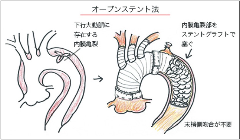 オープンステント法イメージ