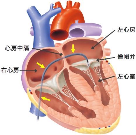 マイトラクリップ（MitraClip®）のイメージ