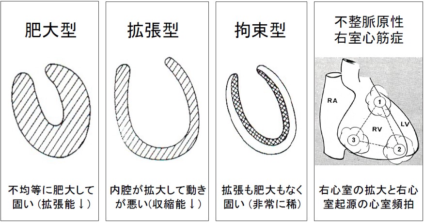 心筋症の5つの病型