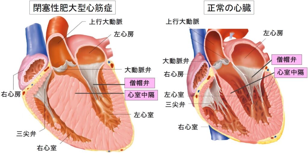 肥大型心筋症（HCM）の心臓と、正常の心臓のイメージ