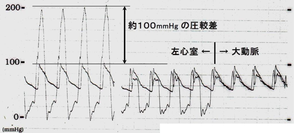 閉塞性肥大型心筋症の心臓カテーテル検査（自験例）